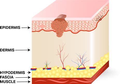 Staging Squamous Cell Skin Cancer: A Practical Description – Skin ...