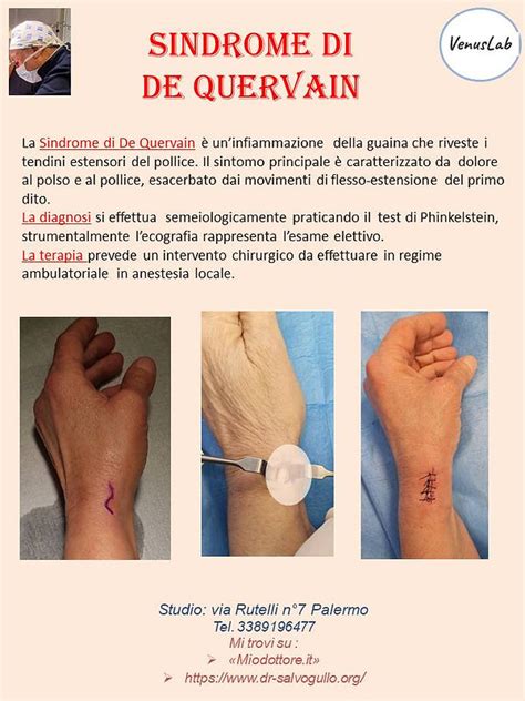 Sindrome Di De Quervain Dr Salvatore Gullo