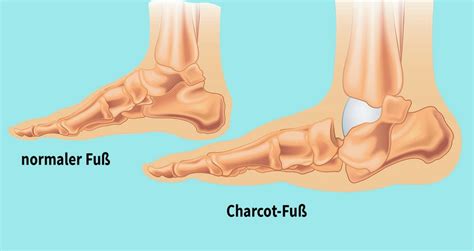 So Erkennt Man Einen Charcot Fu Diabetiker Niedersachsen E V