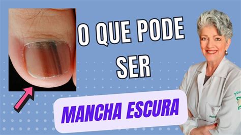 Manchas Escura Nas Unhas Braincp