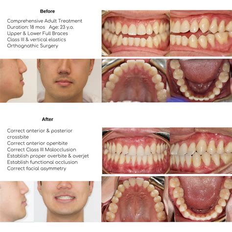 Smile Gallery — Tri Valley Orthodontics