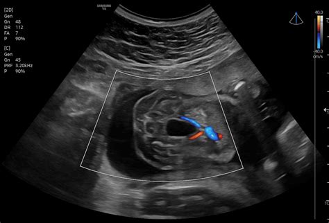 Valores De Refer Ncia Para O Tamanho Da Bexiga Fetal No Segundo E