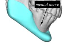 Mental Nerve Location In Custom Jawline Implant Placement Dr Barry