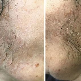 Excess hair growth on the cheeks of the patient, as observed 4 months ...