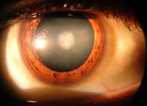 Cataract Dulles Eye Associates