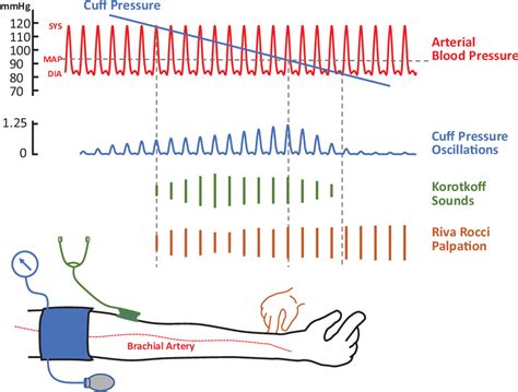 Perioperative Noninvasive Blood Pressure Monitoring Semantic Scholar