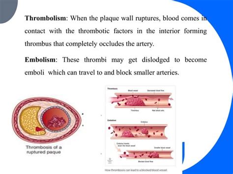 Pathophysiology Of Atherosclerosis Pptx