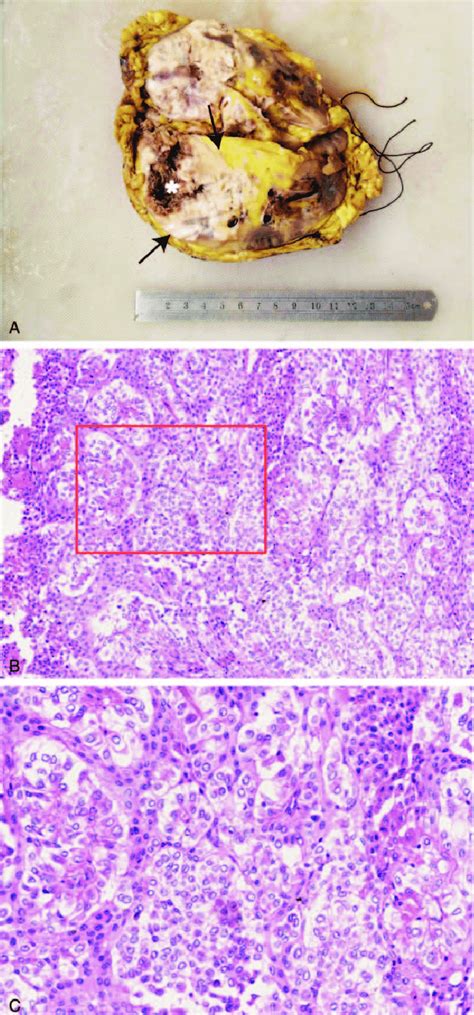 Histologic Findings Of The Tumor A A Well Circumscribed Yellow Tan