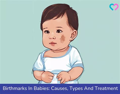 Birthmarks In Babies Causes Types And Treatment