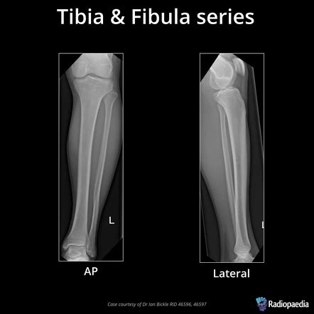 Tibia Fibula Anatomy X Ray