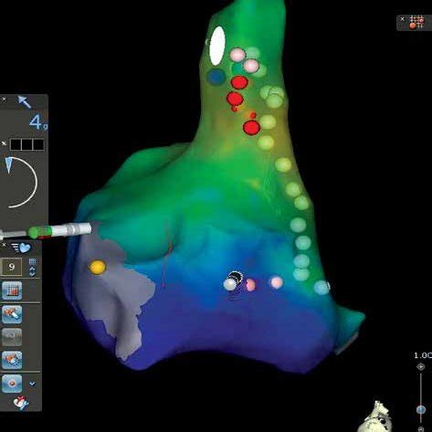 A Electroanatomical Map Of The Right Atrium With Identification Of