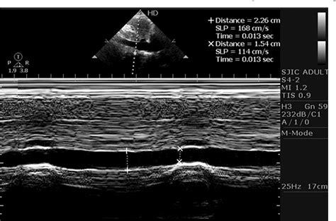 Table 3 From Assessment Of Inferior Vena Cava Diameter By