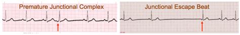 Premature Junctional Complex (PJC) and Junctional Escape Beats - EKG ...