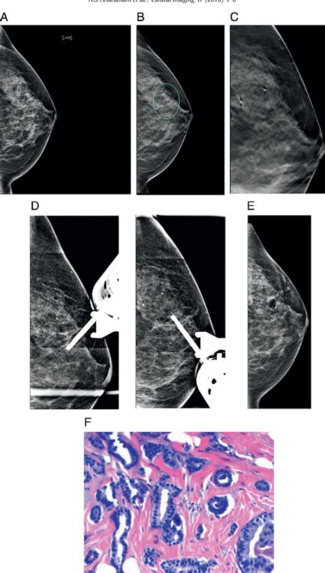 Figure From Digital Breast Tomosynthesis Vacuum Assisted Biopsy For