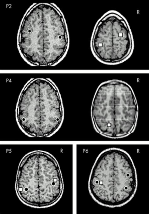 Electromagnetic Function Of Polymicrogyric Cortex In Congenital