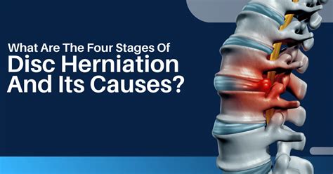 What Are The 4 Stages Of Disc Herniation And Its Causes