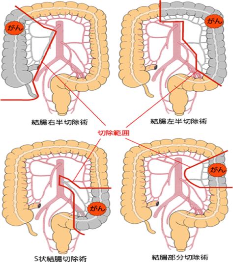 大腸がんの治療 大腸疾患 昭和大学医学部 外科学講座 消化器・一般外科学部門