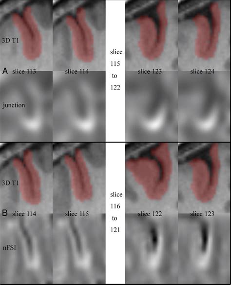 Figure From Mri Abnormalities Predominate In The Bottom Part Of The