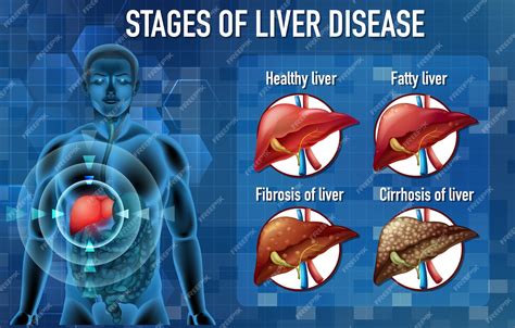 Free Vector | Stages of liver disease