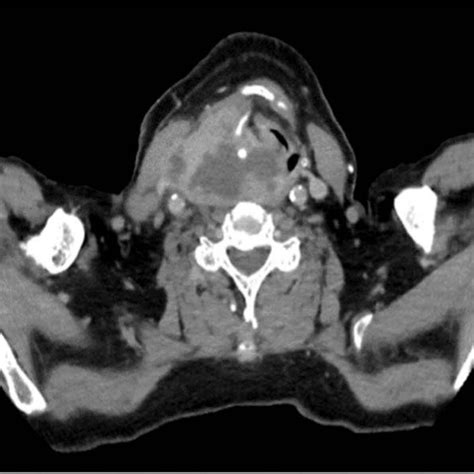 A B Axial View Of Computed Tomography Ct Scans Of The Neck Showing A Download Scientific