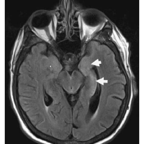 The First Row Shows Brain Mri From Left To Right Dwi Flair And