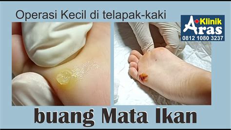 Mata Ikan Di Telapak Kaki Anak 6 Tahun By Dr Seri Anni Klinik Aras