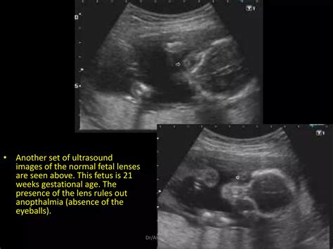 5 Fetal Face Ultrasound Dr Ahmed Esawy Ppt