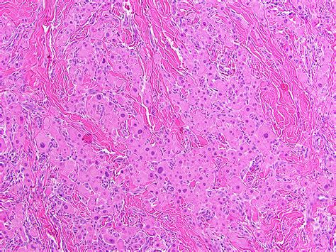 Case 65 Bilateral Testicular Swellings In A Young Male Pathology