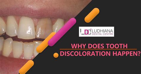 Some Common Causes Of Teeth Discoloration