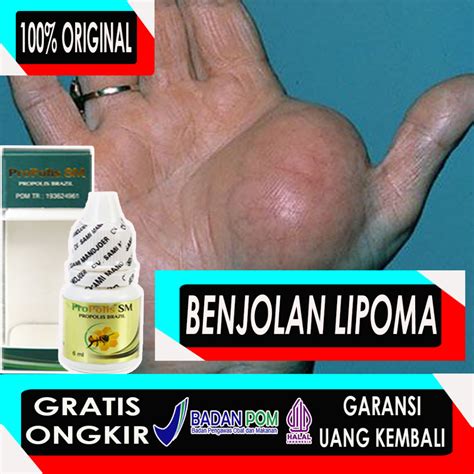 Jual Propolis Sm Obat Pengempis Benjolan Lipoma Obat Lipoma Obat