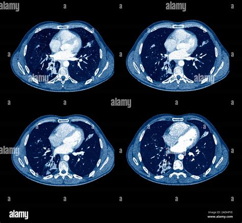 Tuberculosis Coloured Axial Computed Tomography Ct Scans Of Sections