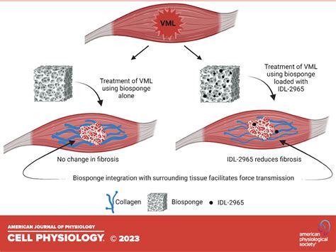 Combined Application Of Biosponges And An Antifibrotic Agent For The