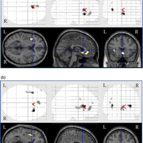 Spm Results From Group Comparison Of Regional Cerebral Blood Flow