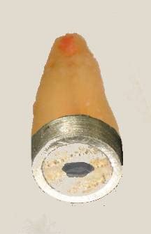 Indirect Restorations. Post-crown Preparations: Understanding The Ferrule Effect (4)