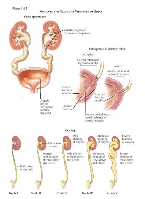 Vesicoureteral Reflux Pediagenosis