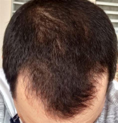 4 Months Using Finasteride And Minoxidil Photo Wrassman M D