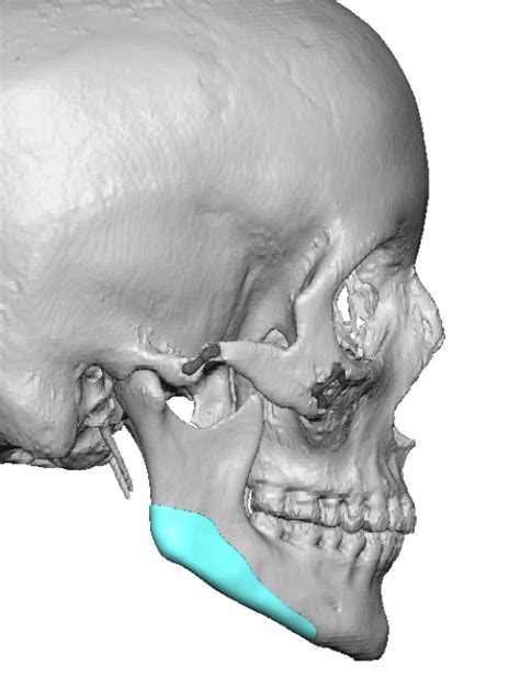 Plastic Surgery Case Study Custom Right Jaw Angle Implant For V Line