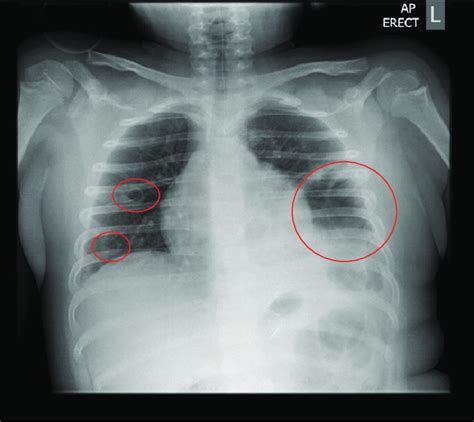 Chest Radiograph On Admission A Large Air Filled Cavity At The Left Download Scientific