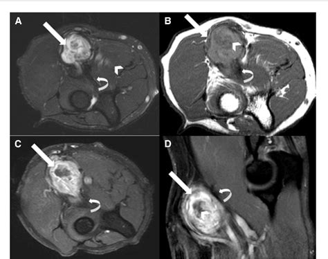 Figure 1 from Distal biceps brachii tendon repair complicated by a ...