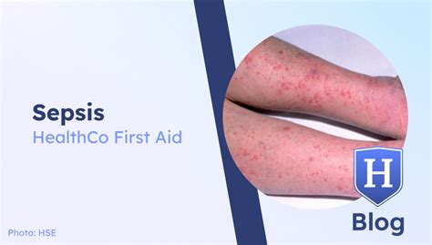 healthco  aid sepsis healthco