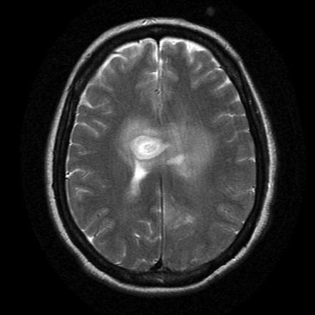 Anaplastic astrocytoma | Radiology Reference Article | Radiopaedia.org