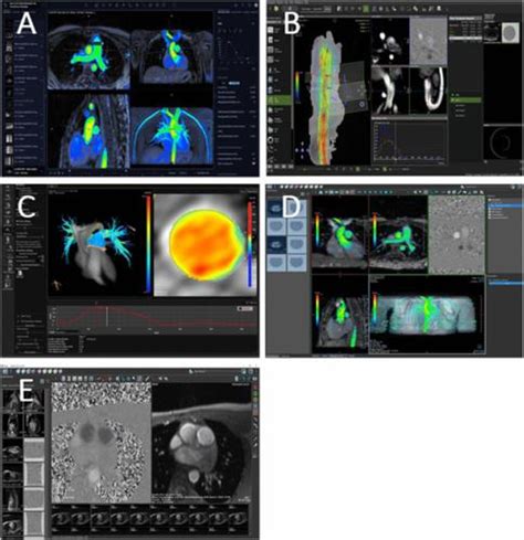 Flow Evaluation Software For Four Dimensional Flow MRI A Reliability