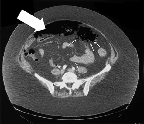 Recurrent Pneumatosis Intestinalis In A Patient With Dermatomyositis Bmj Case Reports