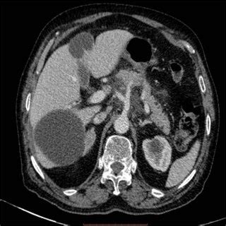 Axial Contrast Enhanced Computed Tomography Reveals Two Round Well