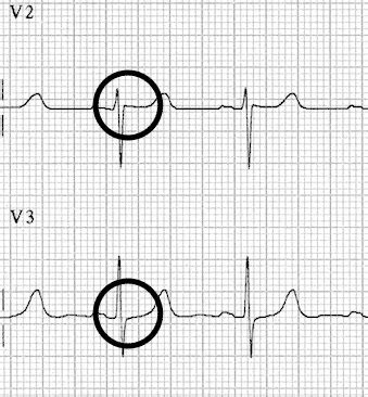 Supraventricular Tachycardia (SVT) • LITFL • ECG Library Diagnosis