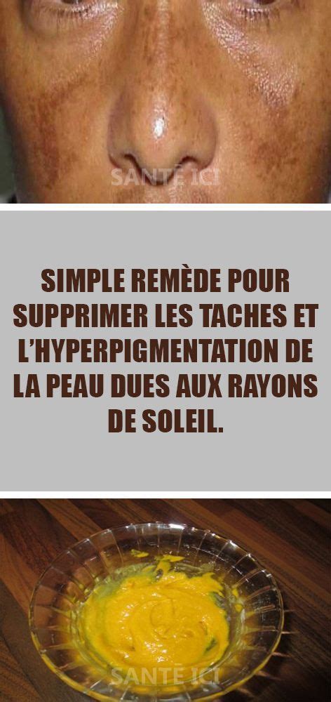 Simple remède pour supprimer les taches et lhyperpigmentation de la