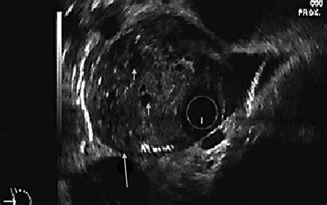 Radial Eus Showed An Iso Hypoechoic Polypoid Mass Lesion Narrowing The Download Scientific