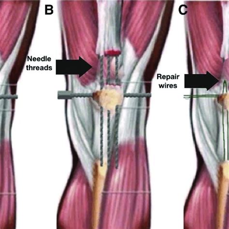 Pdf Surgical Treatment Of Chronic Rupture Of The Quadriceps Using A