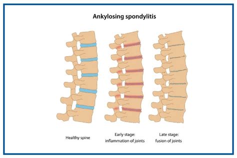 Ankylosing Spondylitis Depicted By 3D Medical Animation 54 OFF