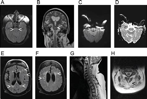 Figure 1 from Central Bradypnea and Ataxic Breathing in Myotonic ...